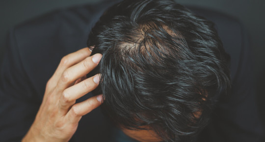 Причини випадіння волосся у чоловіків