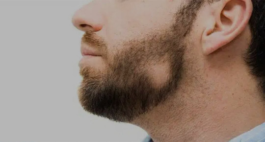 Алопеція на бороді в чоловіків